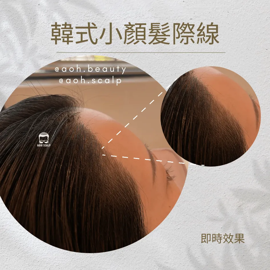 韓式小顏髮際線／SMP髮際線 施術前・即時效果