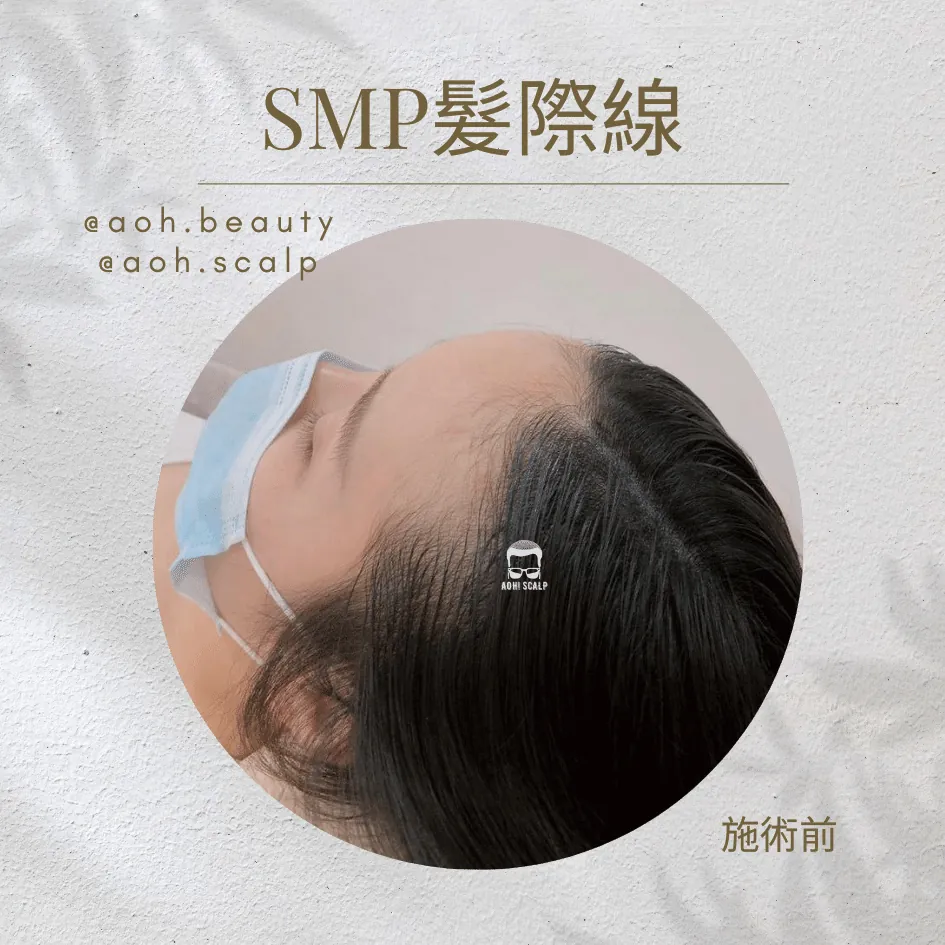 韓式小顏髮際線／SMP髮際線 施術前・即時效果