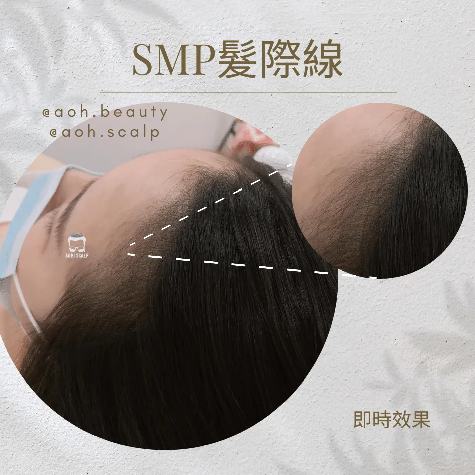 韓式小顏髮際線／SMP髮際線 施術前・即時效果