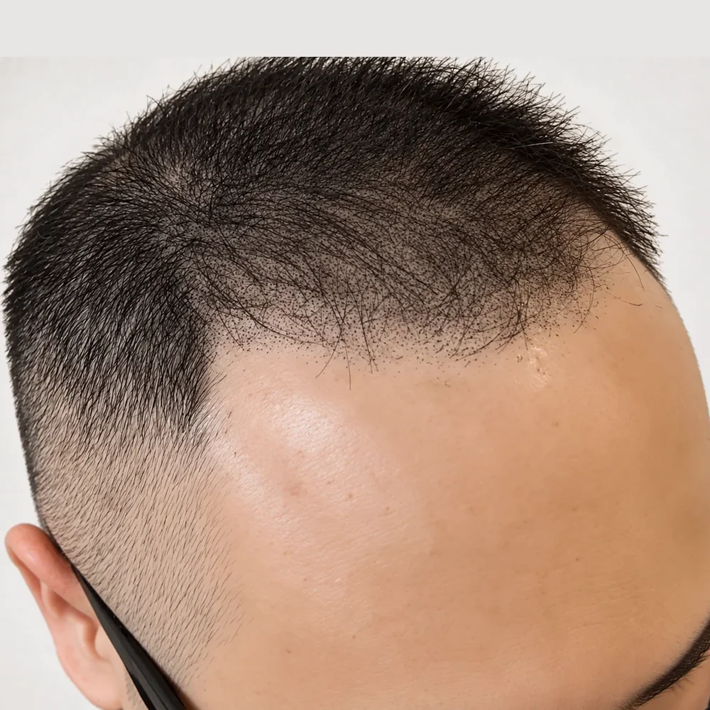 Men's full head · after