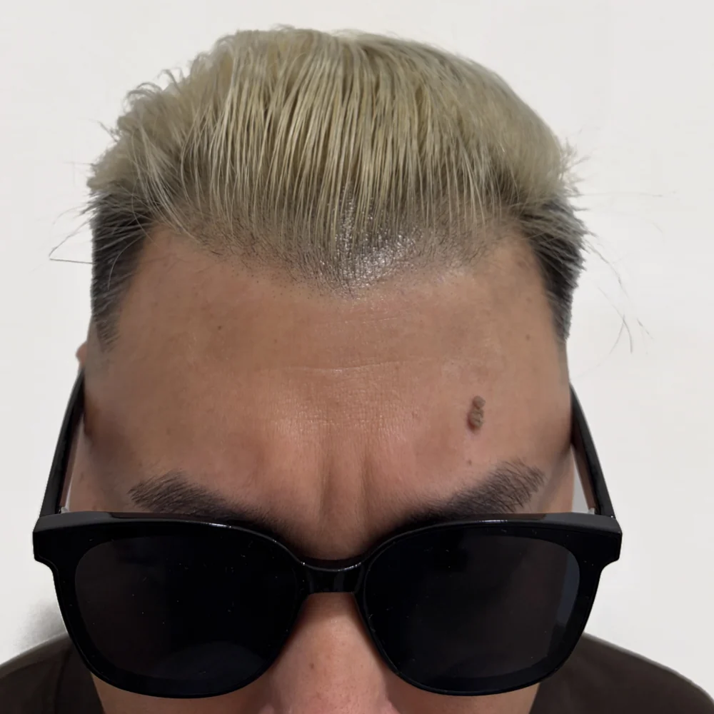 Men's M-shape · hairline · case 2 · after