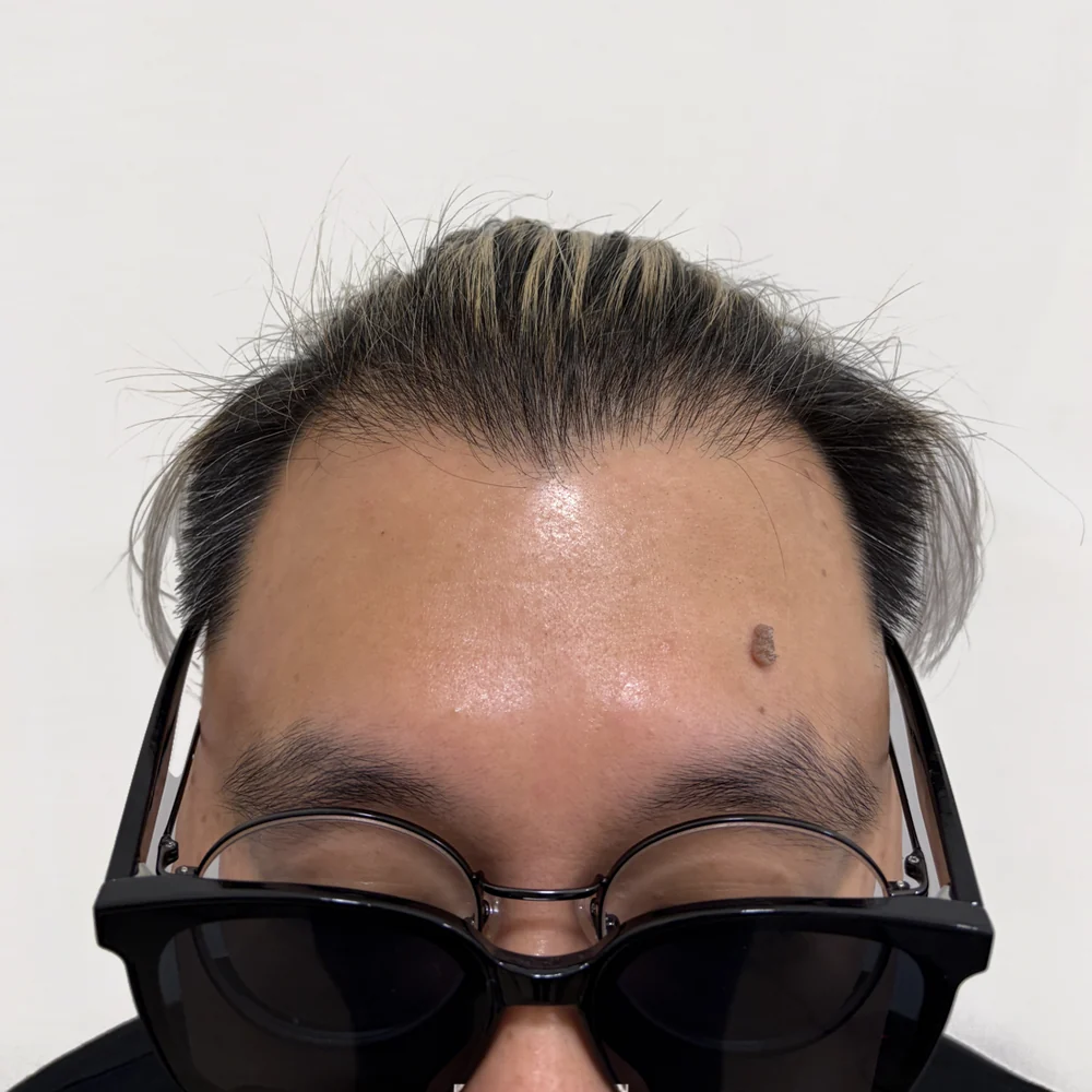 Men's M-shape · hairline · case 2 · before