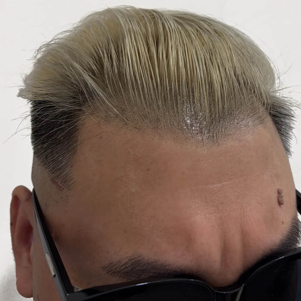 Men's hairline · after