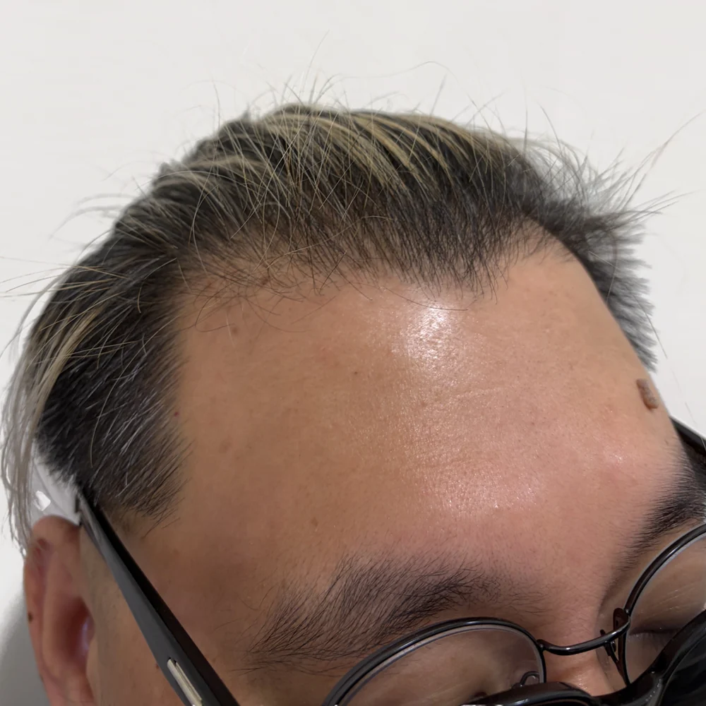 Men's hairline · before