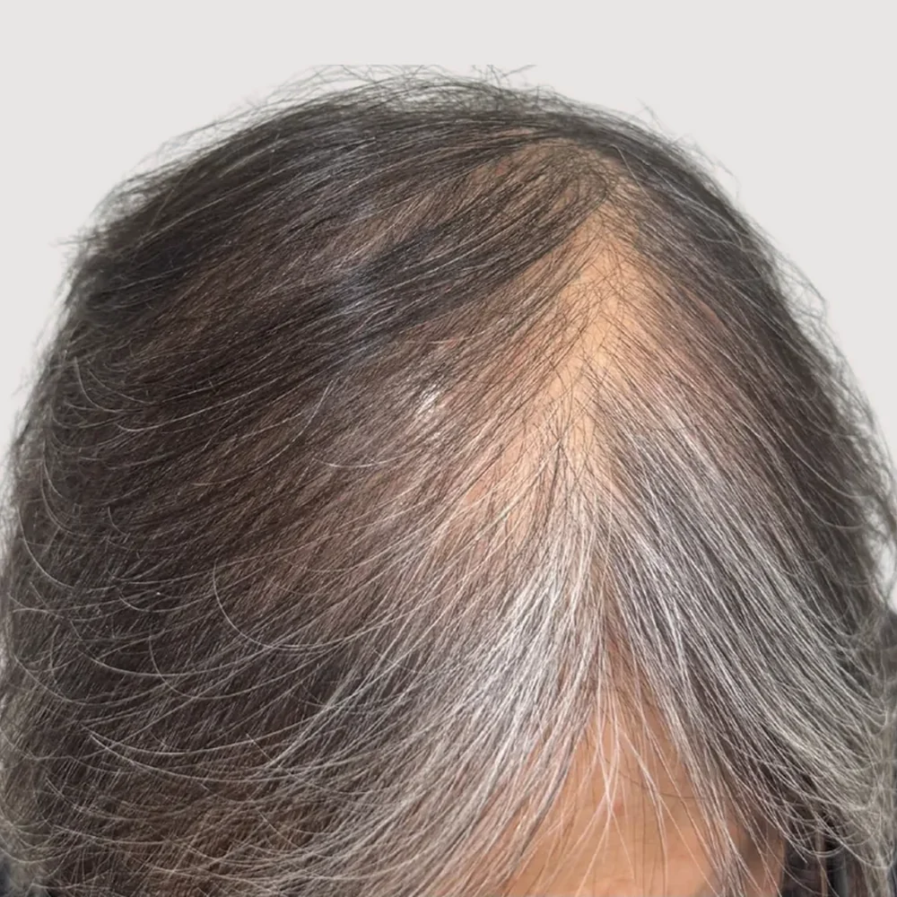 Women's parting · hairline · case 6 · before
