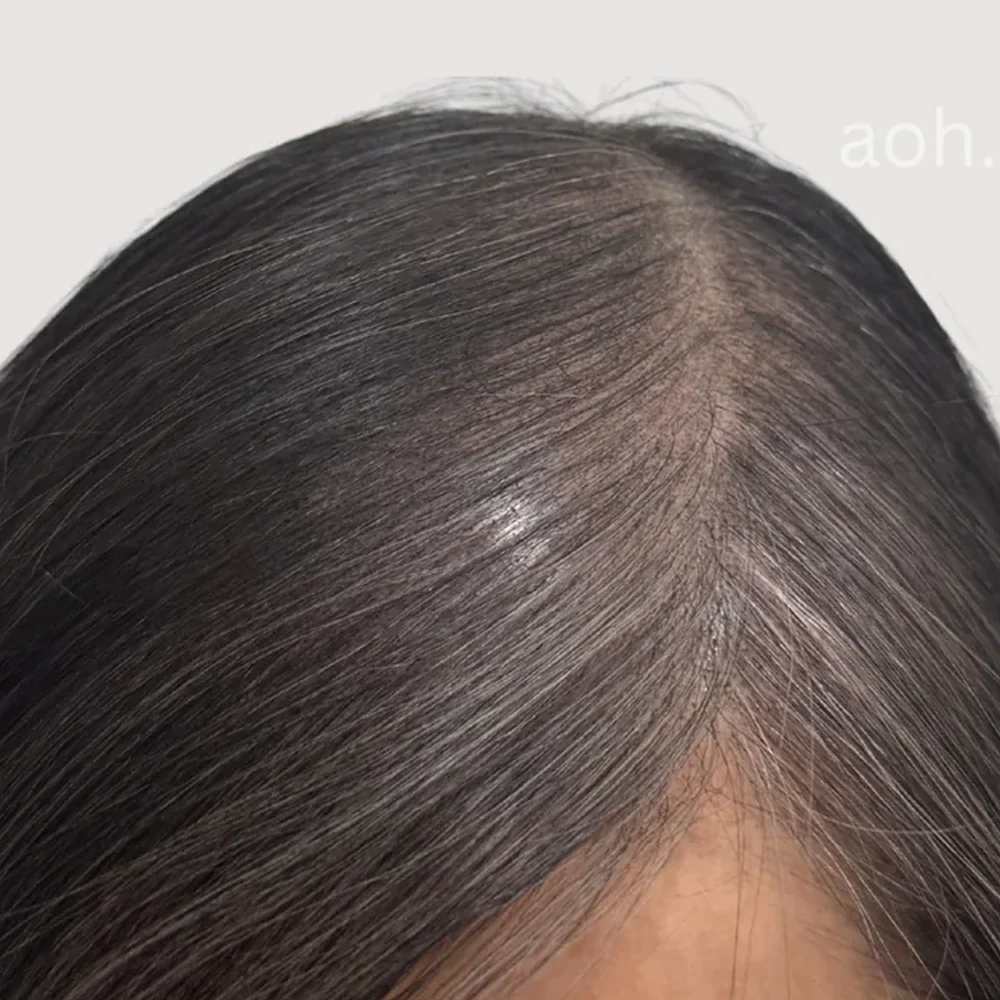 Women's parting · hairline · case 6 · after
