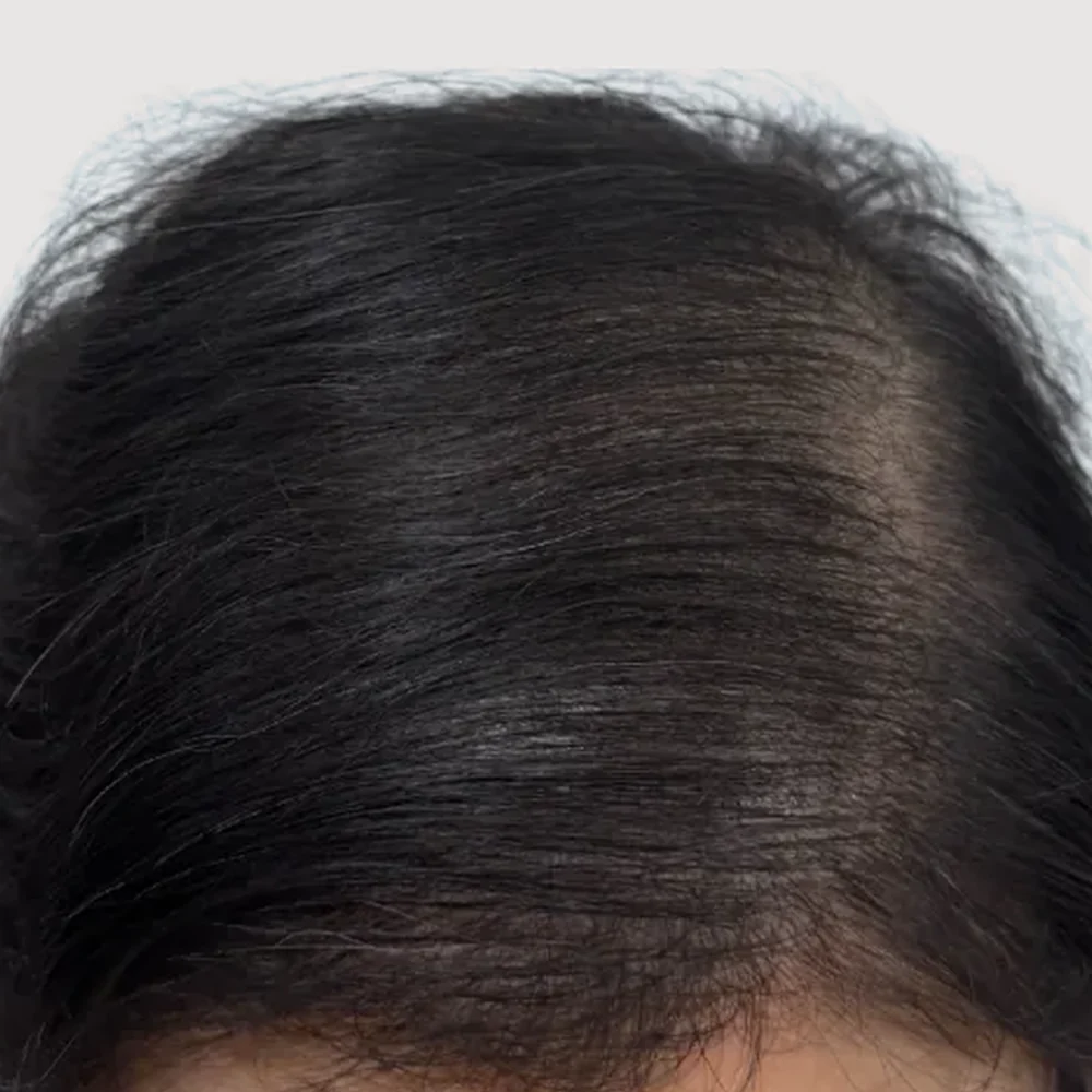 Women's crown · 3 sessions · after