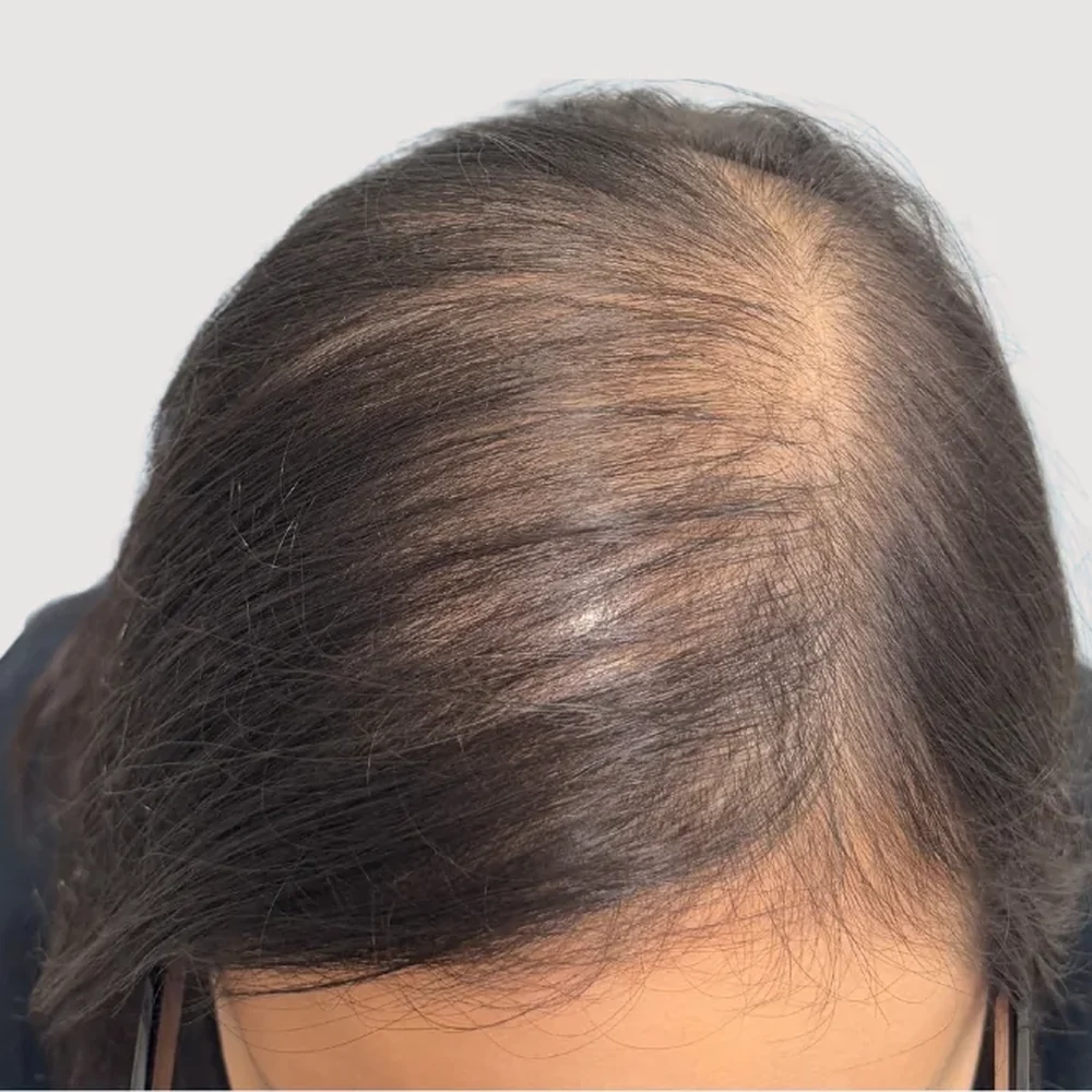 Women's parting · hairline · case 4 · before