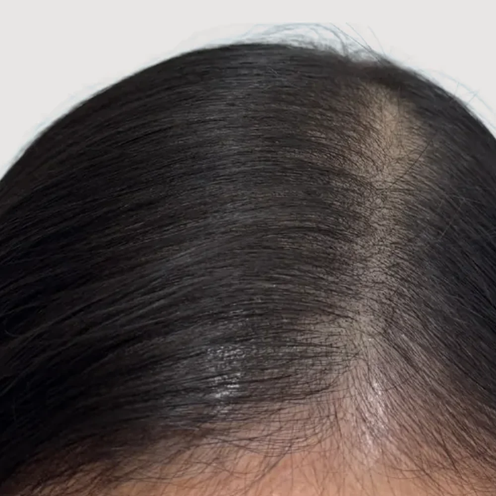 Women's parting · hairline · case 4 · after