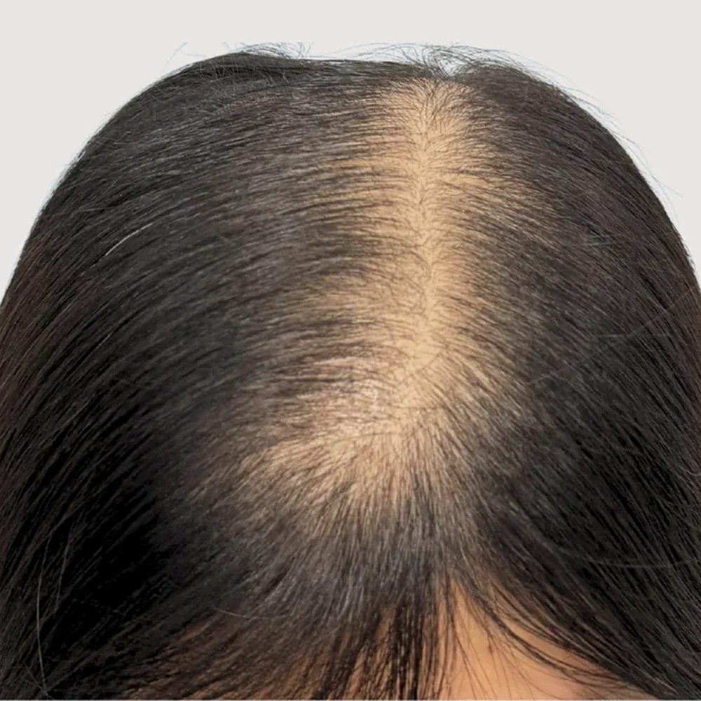 Women's parting · hairline · case 5 · before