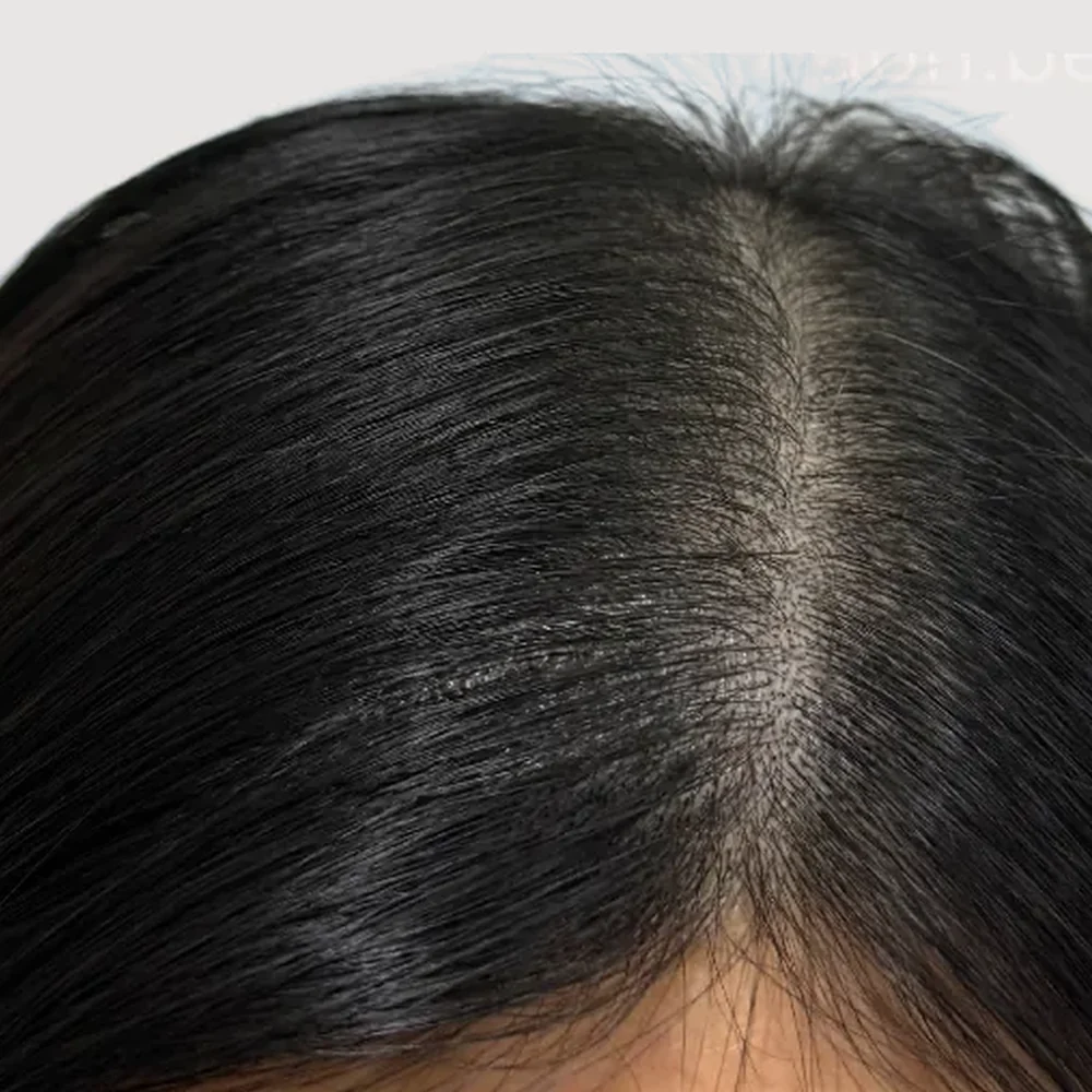 Women's parting · hairline · case 5 · after