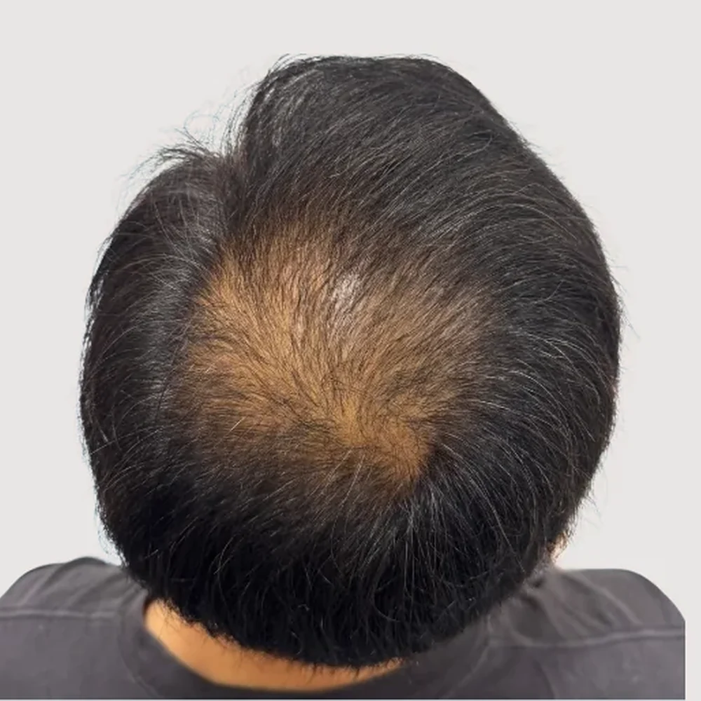 Men's crown · 3 sessions · before