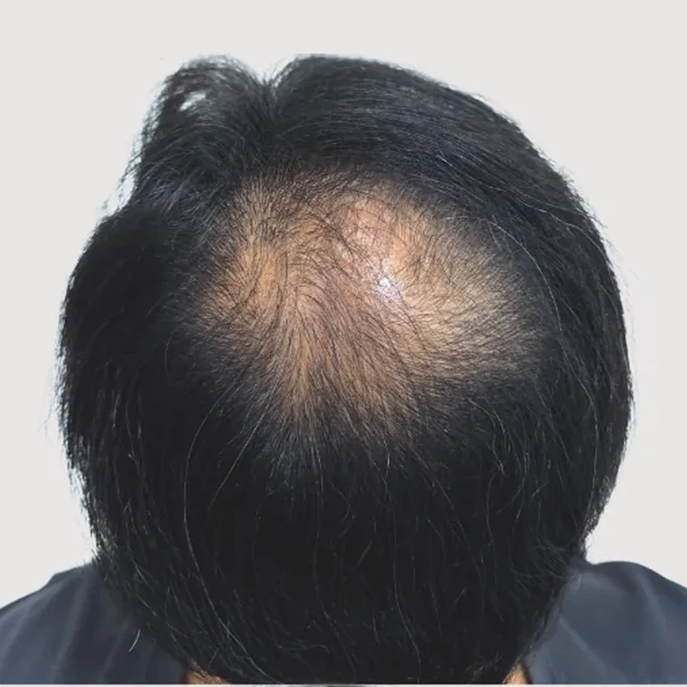 Men's crown · before