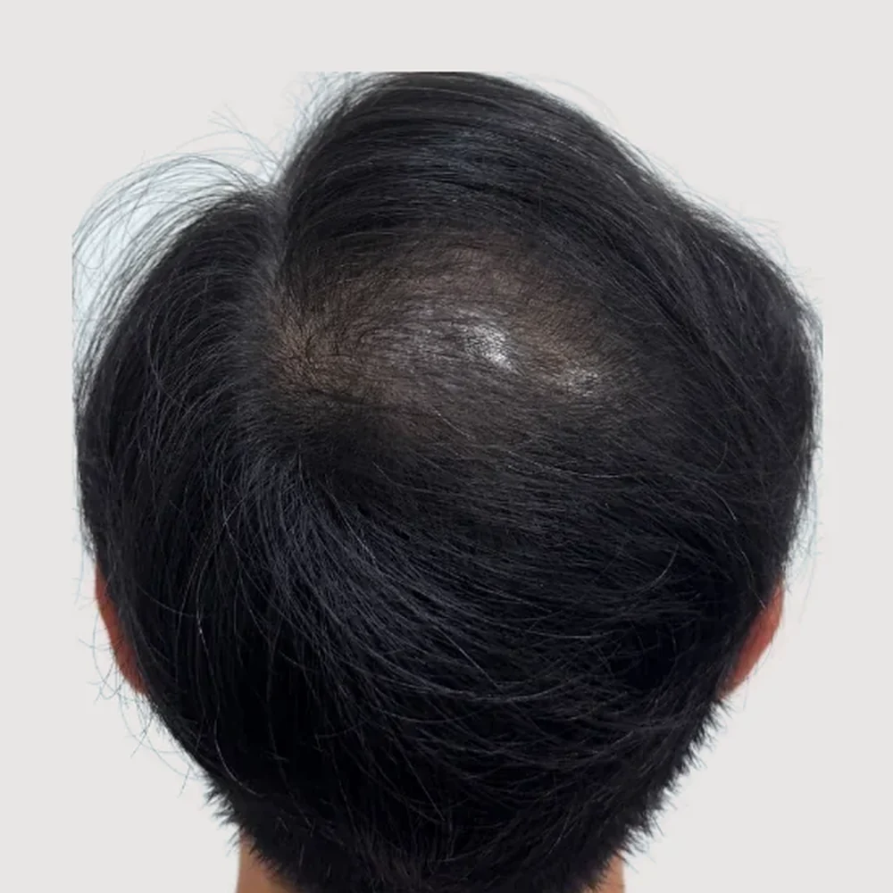 SMP · men's crown · after session 3 · hair not styled