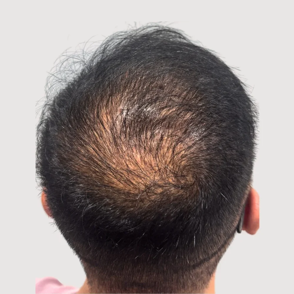 Crown · whorl · case 4 · before