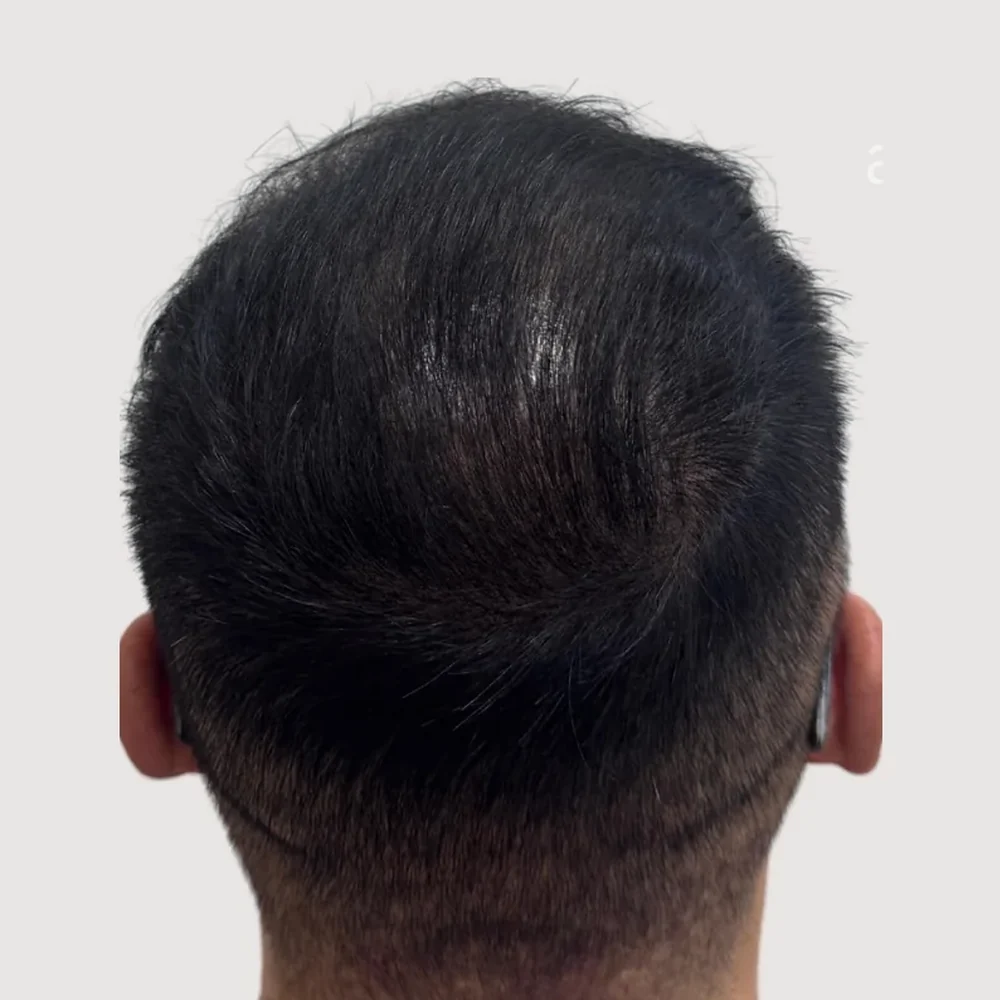 Crown · whorl · case 4 · after