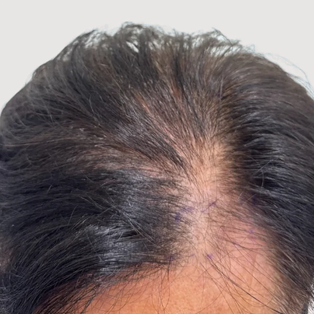 Men's M-shape · hairline · case 4 · before