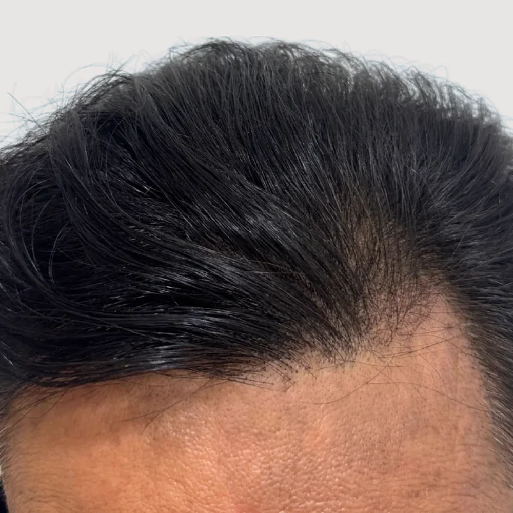 Men's M-shape · hairline · case 4 · after