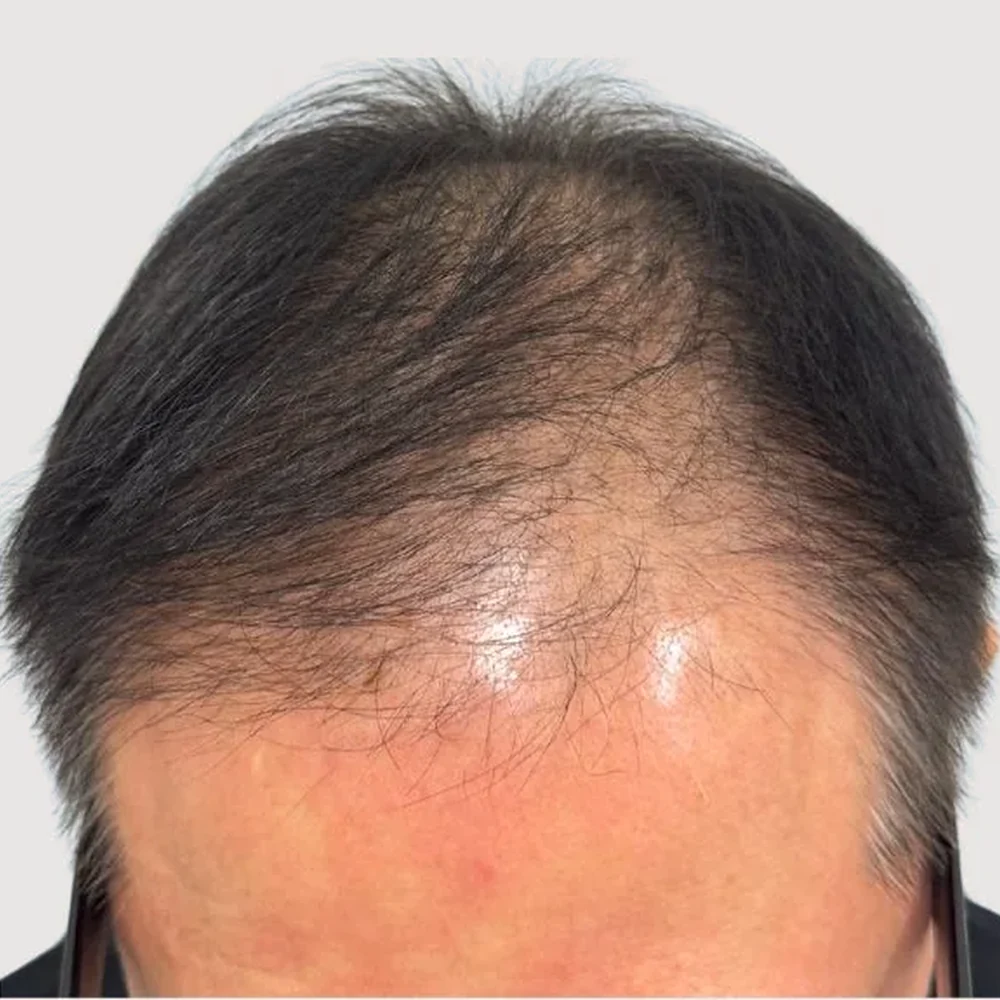 Men's M-shape · hairline · case 3 · before