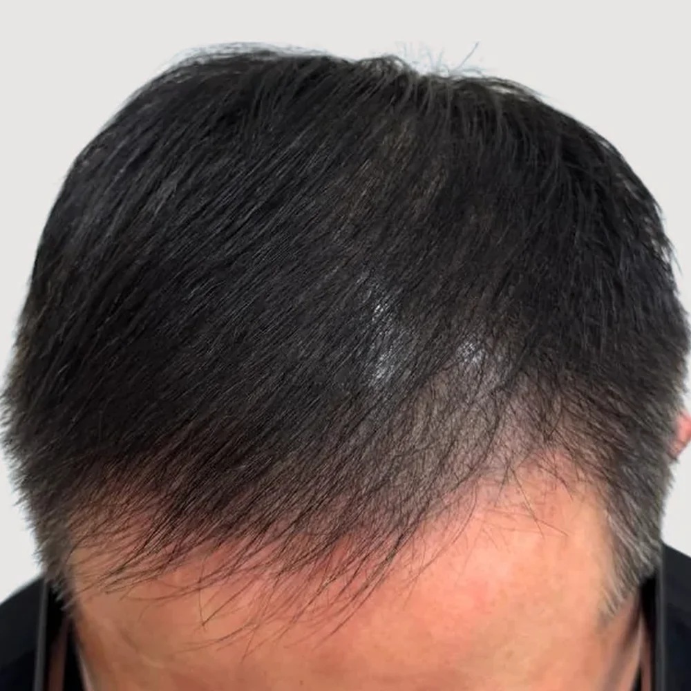 Men's M-shape · hairline · case 3 · after