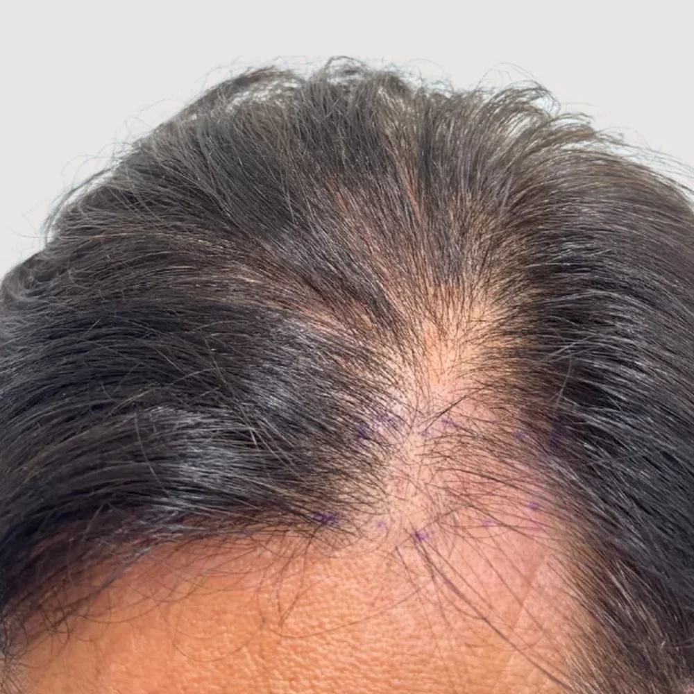 Men's M-shape · hairline · case 5 · before