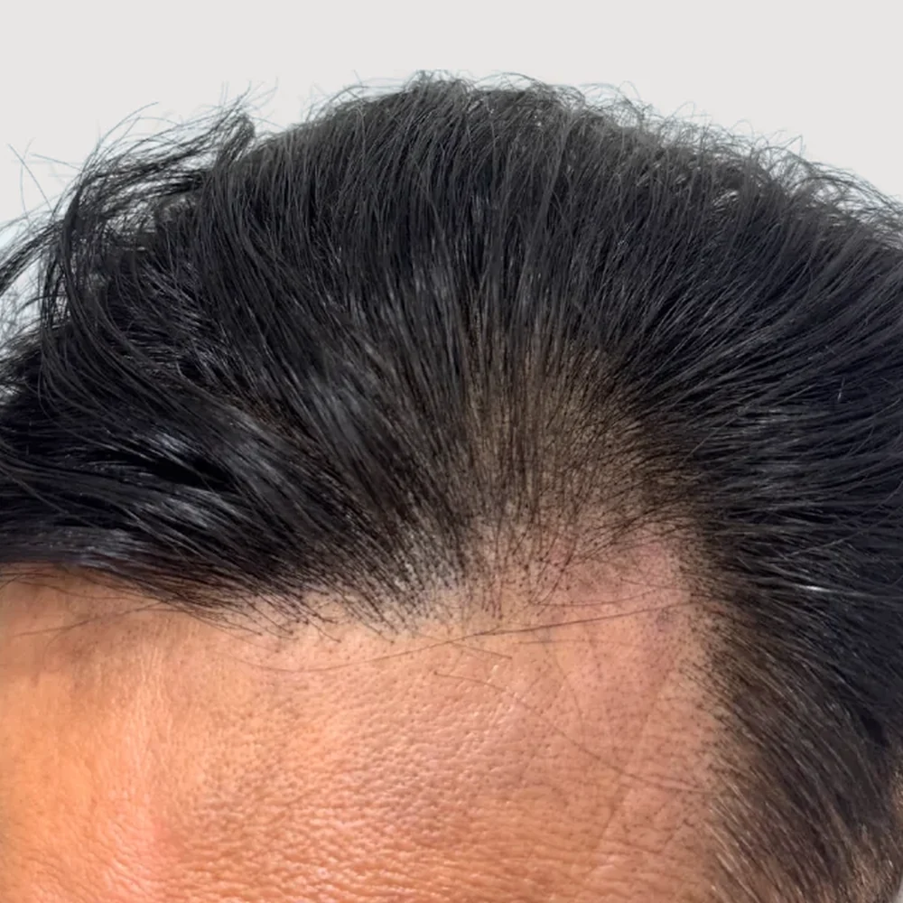 Men's M-shape · hairline · case 5 · after