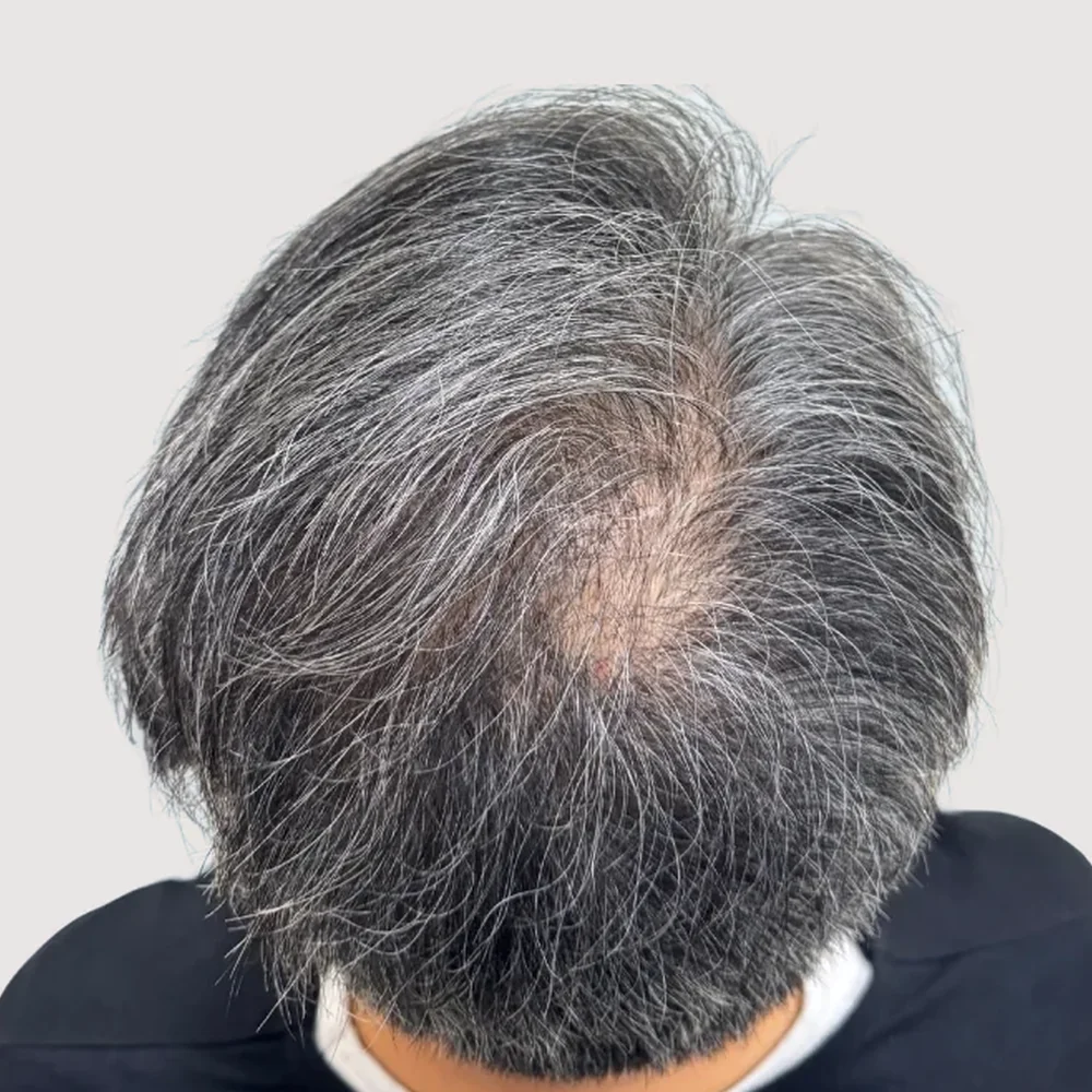 Grey hair · 3 sessions · before