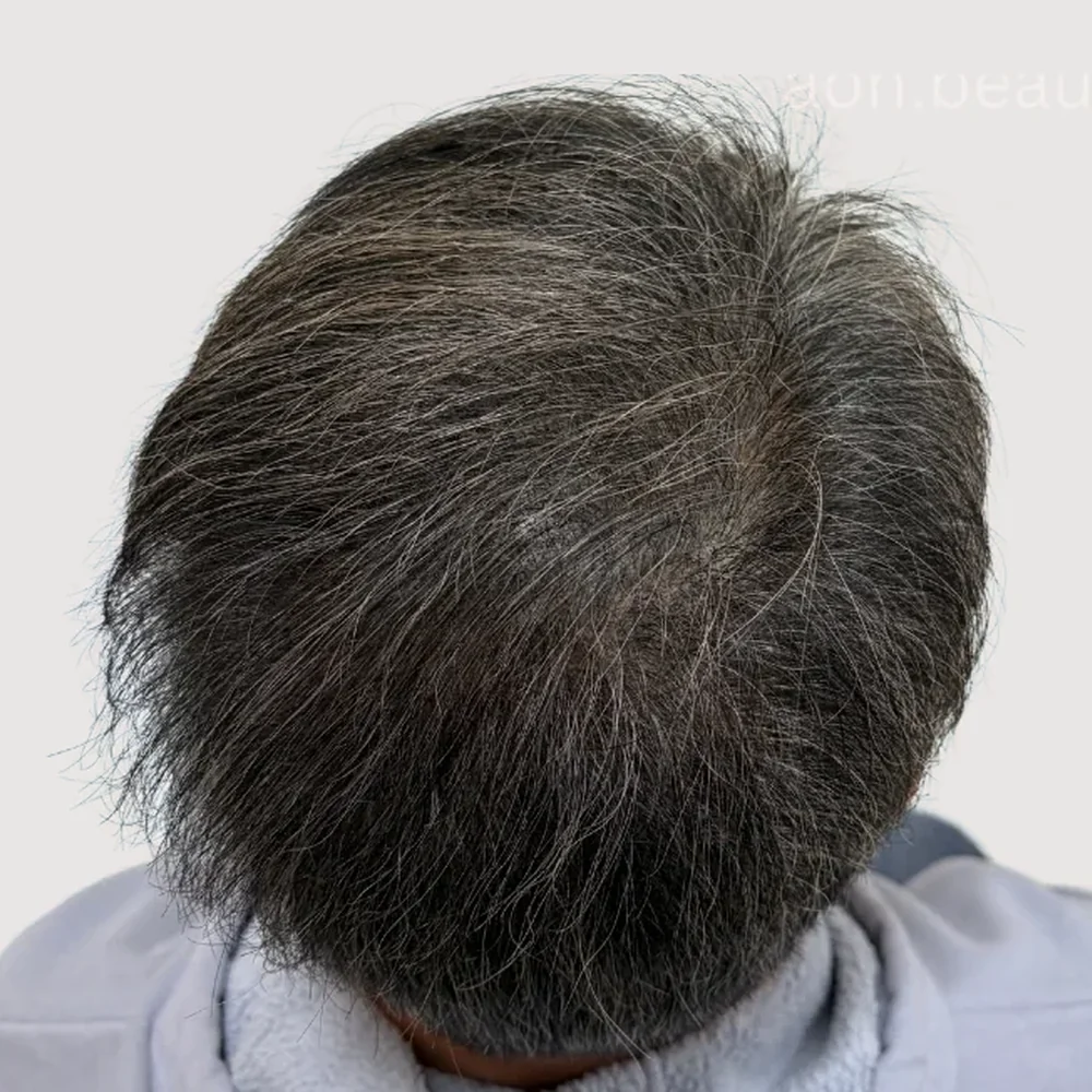 Grey hair · 3 sessions · after