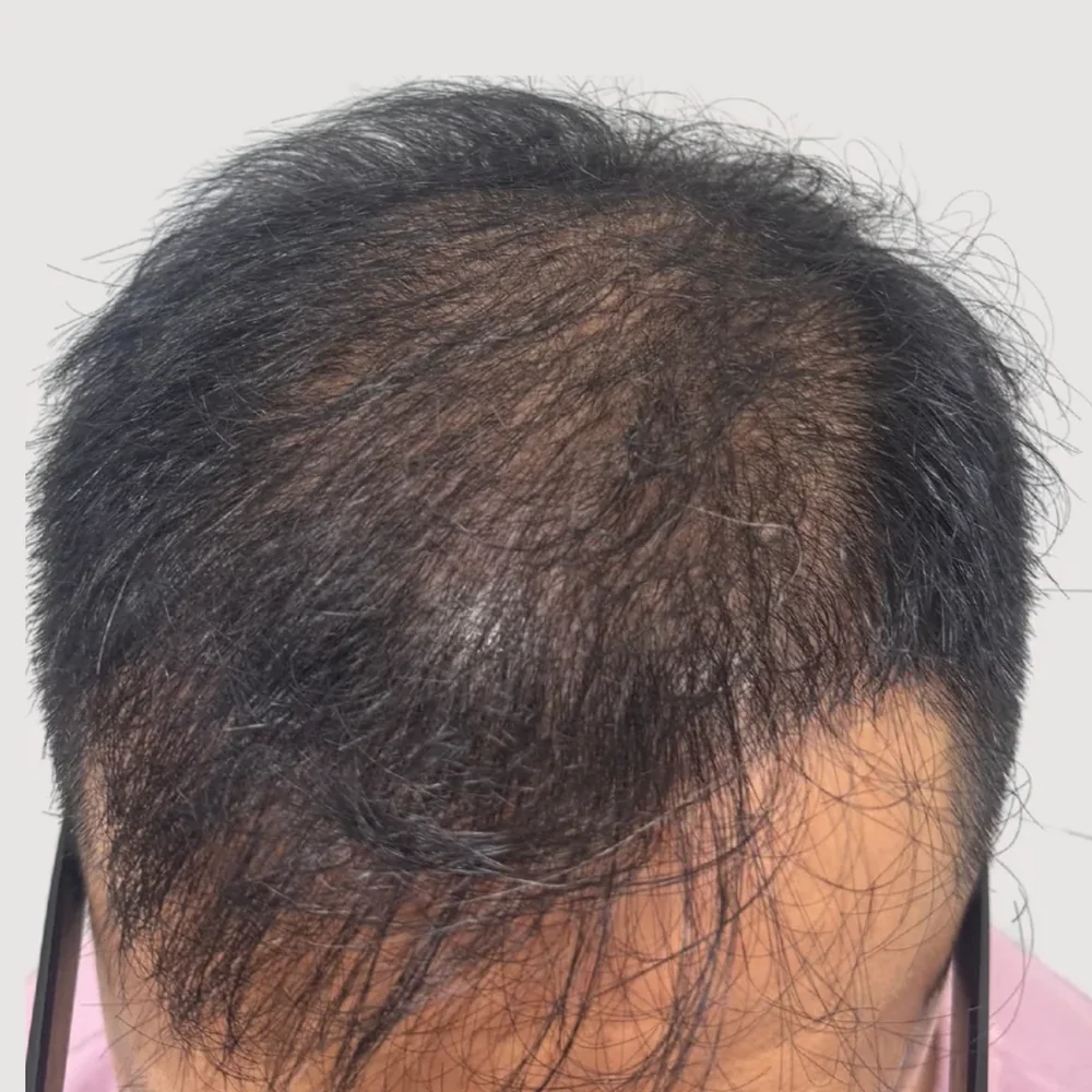 Crown · whorl · case 6 · before