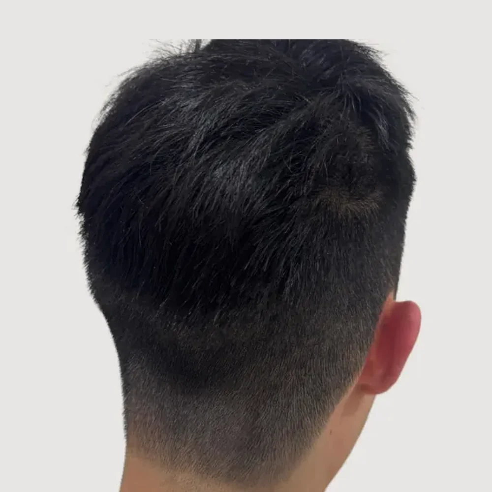 Scars · alopecia areata · case 2 · after