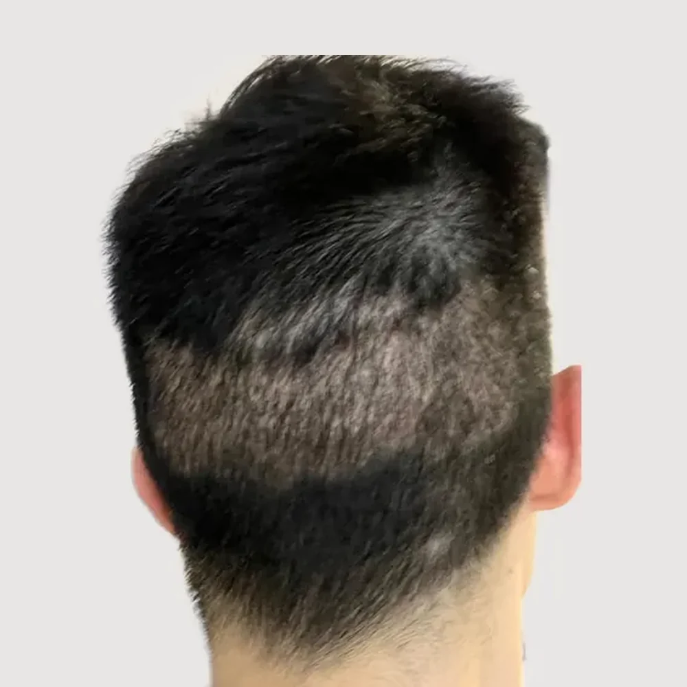 Scars · alopecia areata · case 2 · before