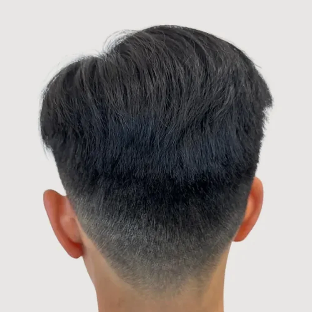 Scars · alopecia areata · case 3 · after