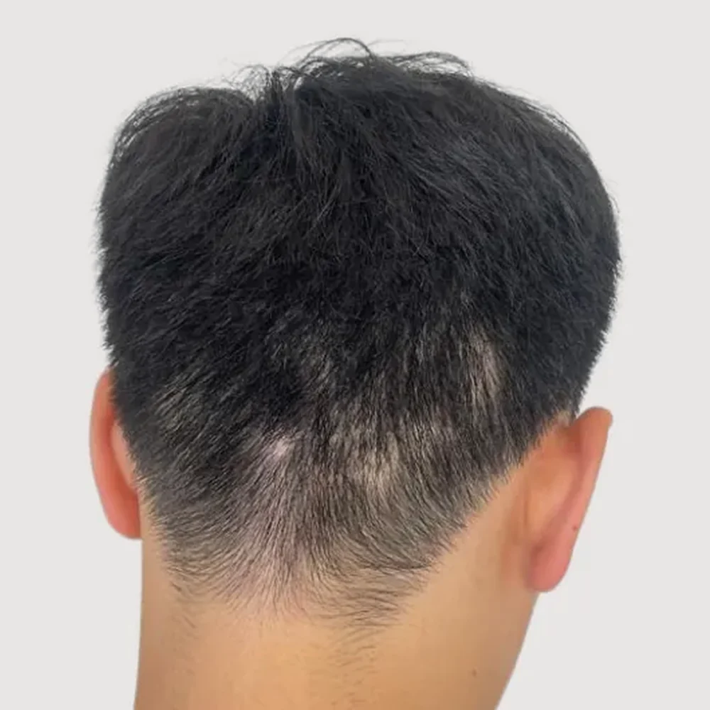 Scars · alopecia areata · case 3 · before