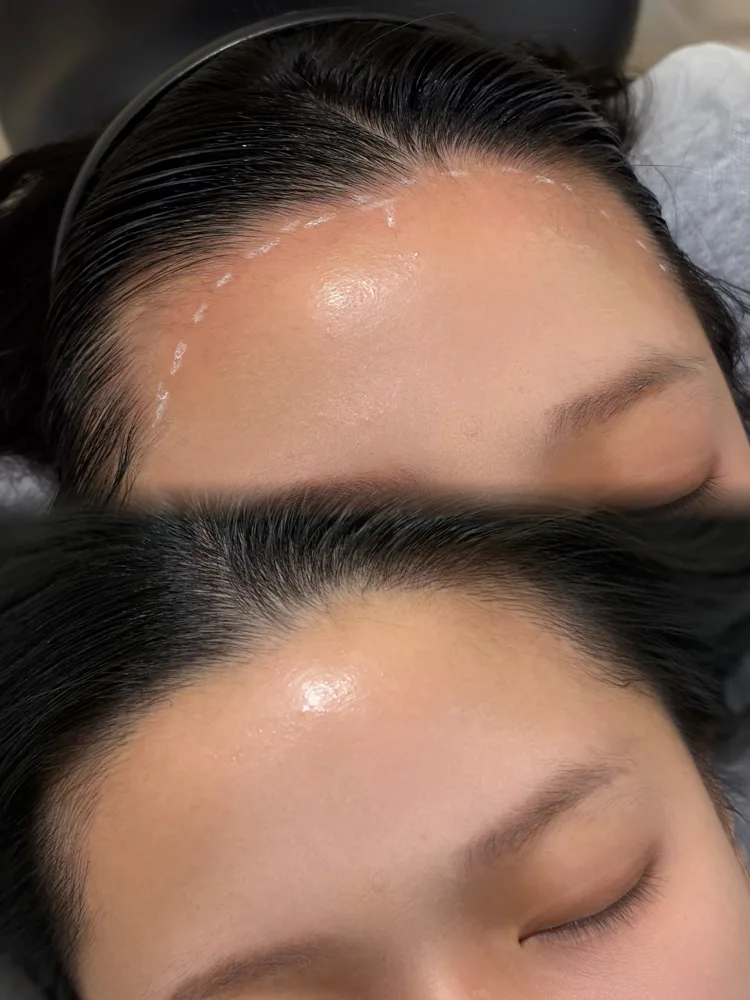 Face-framing hairline · before and after